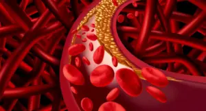 Rappresentazione 3D di un'arteria con accumulo di colesterolo e globuli rossi nel sangue