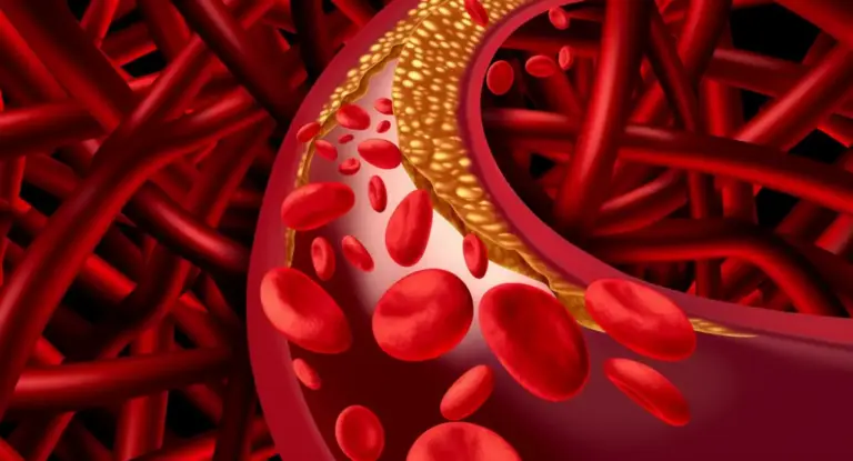 Rappresentazione 3D di un'arteria con accumulo di colesterolo e globuli rossi nel sangue